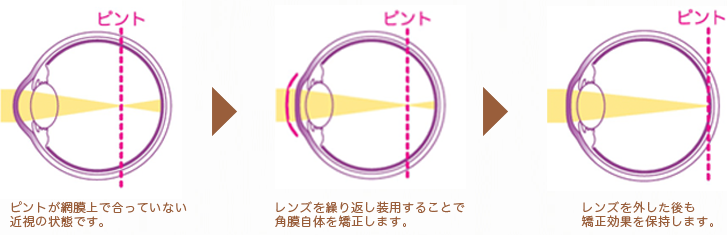 Ill orthokeratology